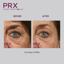 Load image into Gallery viewer, PRX Dermal Perfexion- In office treatment only
