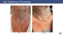 Load image into Gallery viewer, SylfirmX RF Microneedling