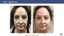 Load image into Gallery viewer, SylfirmX RF Microneedling