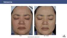 Load image into Gallery viewer, SylfirmX RF Microneedling